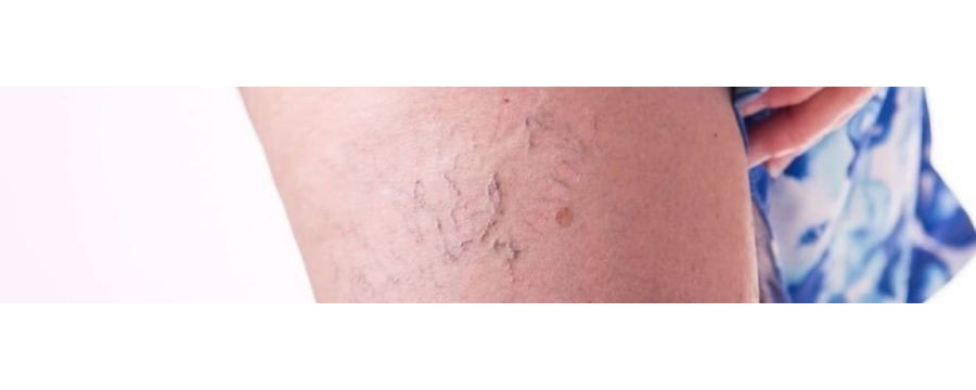 Varices