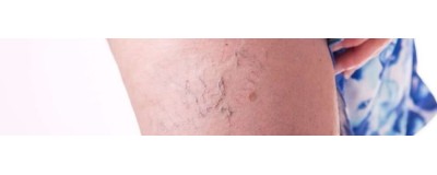 Varices