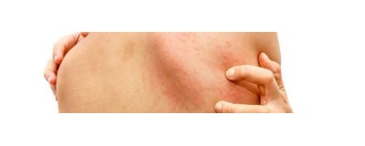 Dermatitis